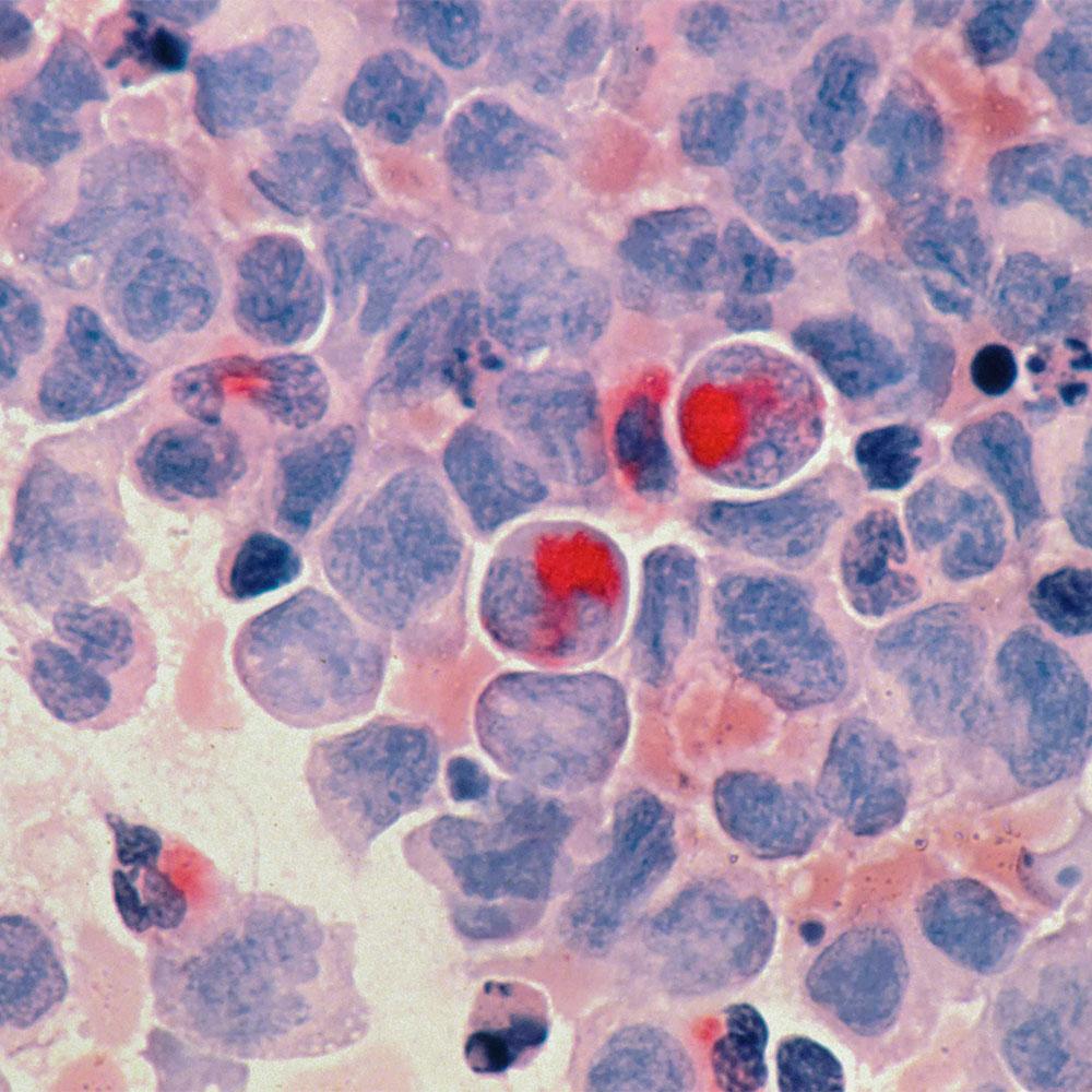 Microscopic view of Acute Myelocytic Leukaemia